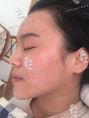 調理激素皮炎，中醫康復實錄 | 龍翔天潤患者案例分享
